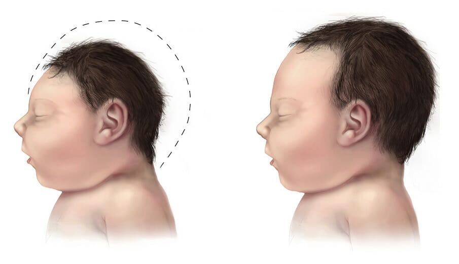 baby with microencephaly